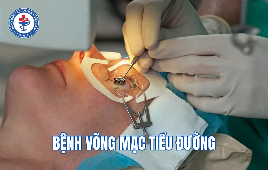 Bệnh võng mạc tiểu đường