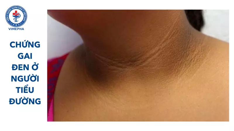 chứng gai đen ở người tiểu đường