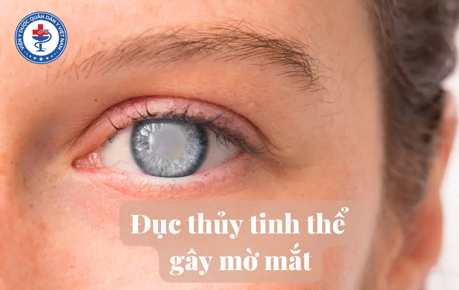 Đục thuỷ tinh thể