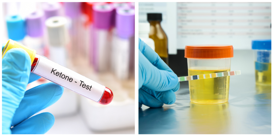 Kiểm tra nước tiểu người tiểu đường