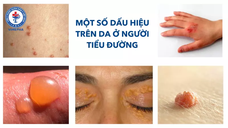 Một số dấu hiệu trên da ở người tiểu đường