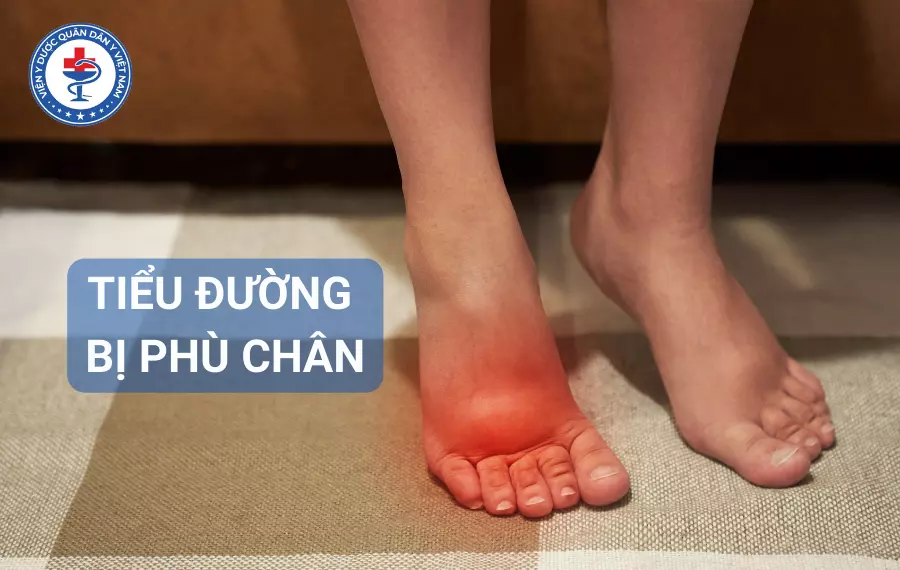 Tiểu đường bị phù chân