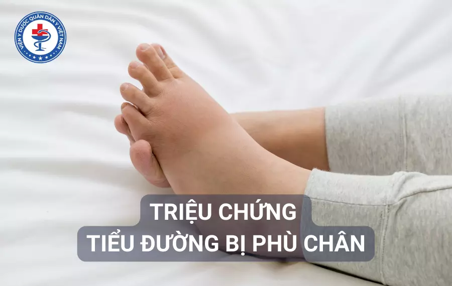 Triệu chứng phù chân